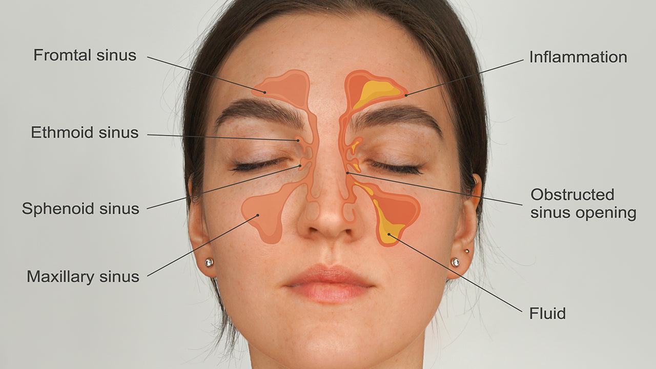 What You Need to Know About Sinus Infections and How They Make You