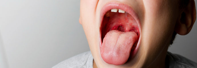 What are the Complications of Untreated Strep Throat?