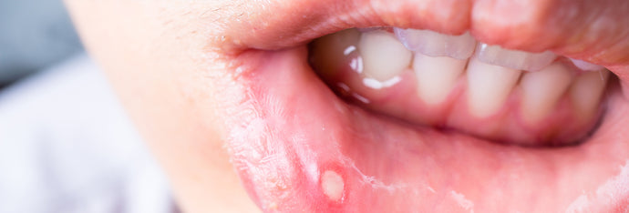 Herpes Esophagitis vs. Strep Throat: How Can You Tell The Difference?