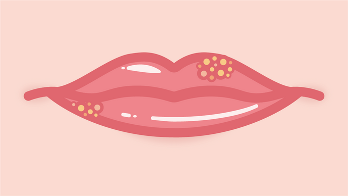What Are the Different Types of Herpes Complexes?