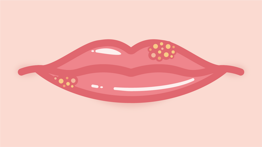 What Are the Different Types of Herpes Complexes?